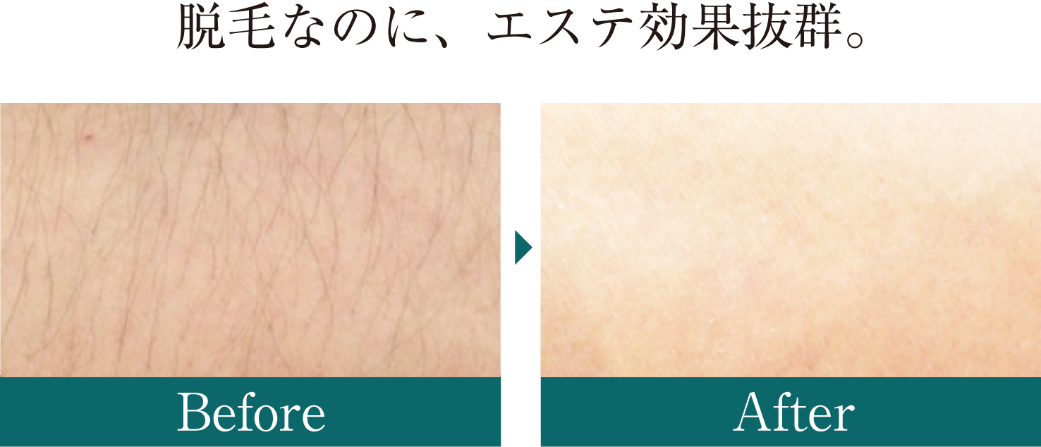 脱毛なのに、エステ効果抜群。